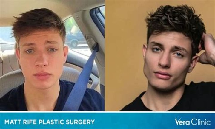 "Matt Rife Before Surgery" Uncovered